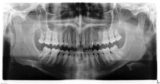 Teeth x-ray, by Justin Mclean on Flickr